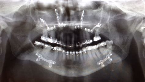 can you box with metal plates in jaw|fixing plates after corrective jaw surgery.